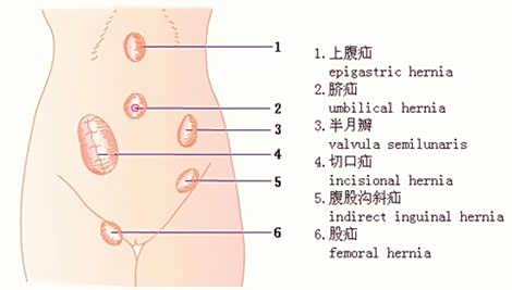 疝气的症状图片