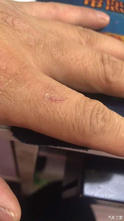 手背也是伤口,谢谢大家观赏!